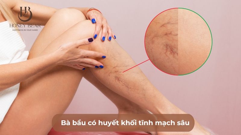 Bà bầu có huyết khối tĩnh mạch sâu