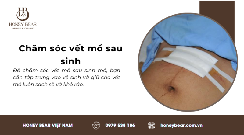 Chăm sóc vết mổ sau sinh