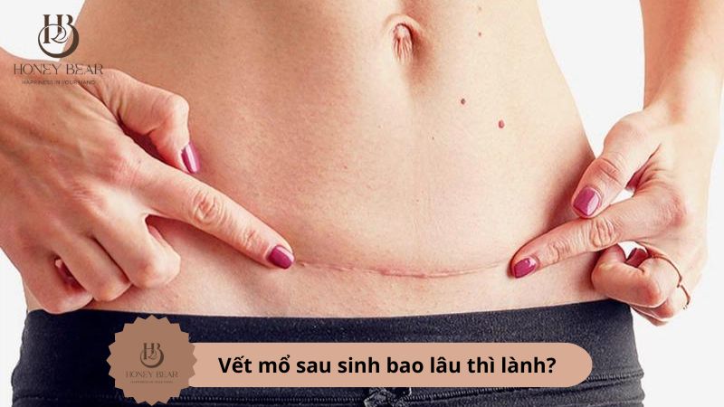 Vết mổ sau sinh bao lâu thì lành?