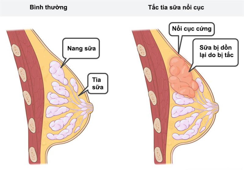 Biểu hiện khi mẹ bị tắc tia sữa